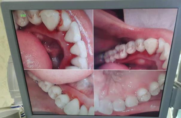 株洲優(yōu)伢仕口腔醫(yī)院潔牙