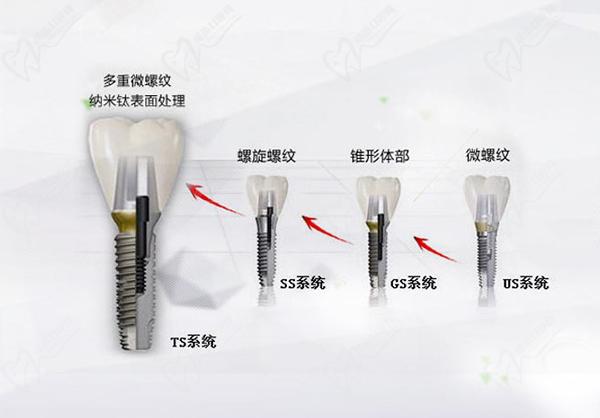 韓國OSSTEM奧齒泰種植牙