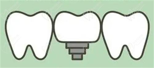 株洲優(yōu)伢仕口腔醫(yī)院種植牙靠譜