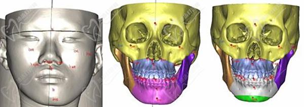 廣州穗華口腔正頜手術術前設計