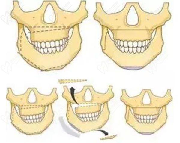 第四軍醫(yī)大正頜手術(shù)