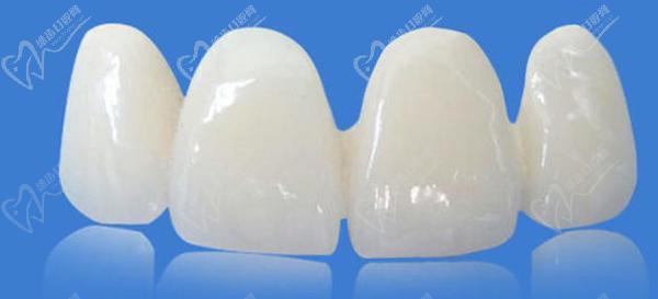 冰瓷牙和全瓷牙哪一個(gè)更好？看完冰瓷牙和全瓷牙的區(qū)別就明了