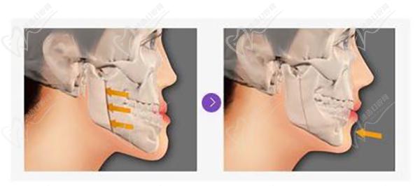 沈陽(yáng)正頜手術(shù)可以醫(yī) 保報(bào)銷(xiāo)嗎