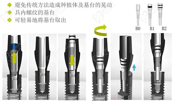 瑞士百丹特種植體官網(wǎng)介紹