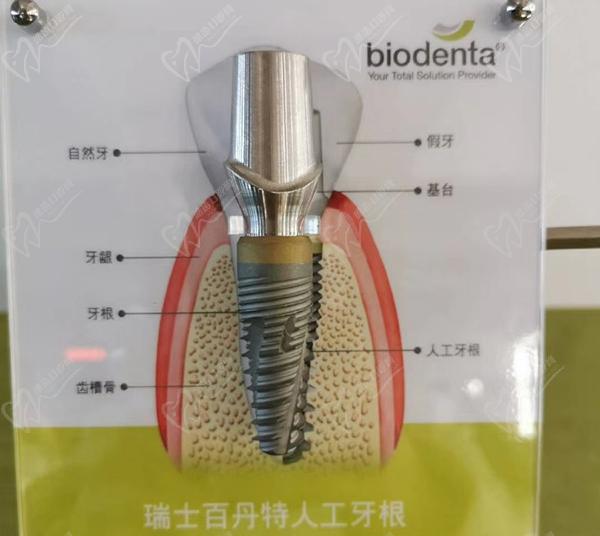 百丹特種植體價(jià)格