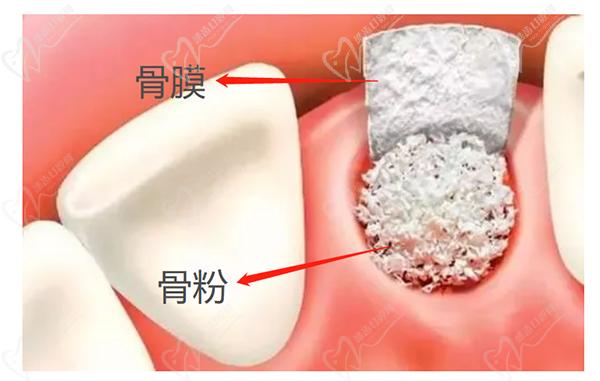 種植牙植骨需要多長時間與骨結(jié)合