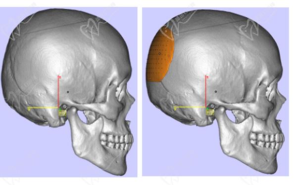 上海后腦勺整形醫(yī)院排名二——上海時(shí)光整形外科醫(yī)院后腦勺整形