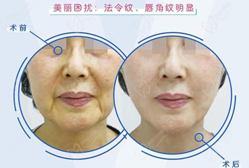 韓國普羅菲耳小切口三重提升術(shù)