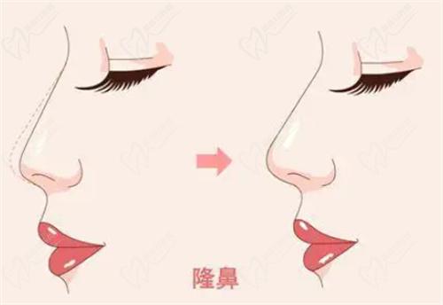 毛運(yùn)春醫(yī)生做鼻子怎么樣？