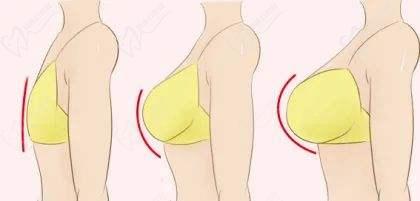 隆胸預(yù)約網(wǎng)上報名