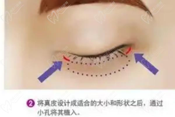 北京薛紅宇醫(yī)生眼袋項目簡介