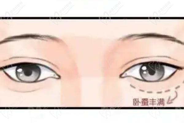 北京薛紅宇醫(yī)生做眼袋預(yù)約掛號