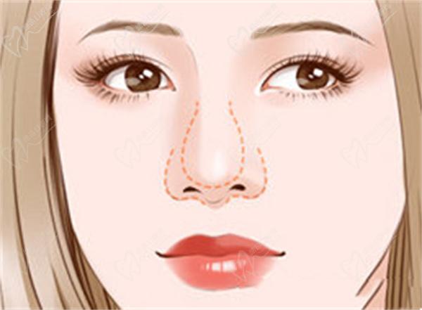 上海葉麗萍醫(yī)生做鼻基底手術(shù)嗎？