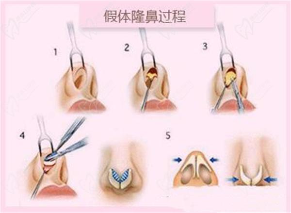 上海葉麗萍醫(yī)生做鼻基底手術(shù)嗎？