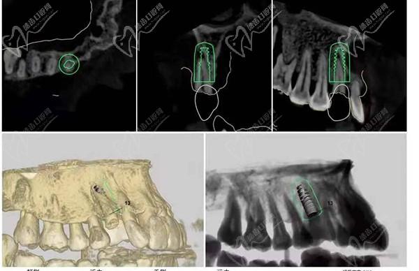 2025集采種植牙哪個(gè)牌子質(zhì)量好價(jià)格便宜？瑞士ITI低至6855元/韓國(guó)登騰2380元起