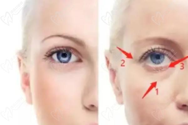 北京薛紅宇醫(yī)生眼袋做得好嗎？北京做眼袋排名前三的自然派醫(yī)生口碑實(shí)例超好